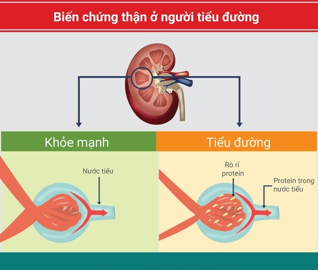 Đái tháo đường là nguyên nhân hàng đầu gây suy thận